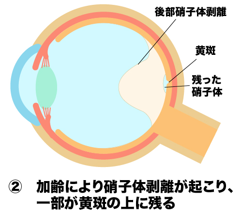 加齢により硝子体剥離が起こる