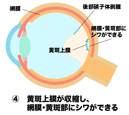 網膜、黄斑部にシワができる