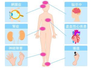 糖尿病が引き起こす合併症