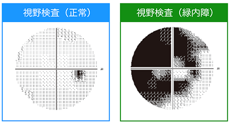 視野検査(正常)視野検査(緑内障)