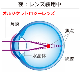 オルソケラトロジーによる近視矯正の仕組み2