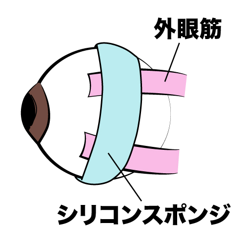 バックリンク手術